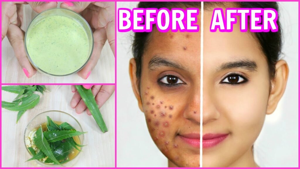 How to Remove Pimples Effectively